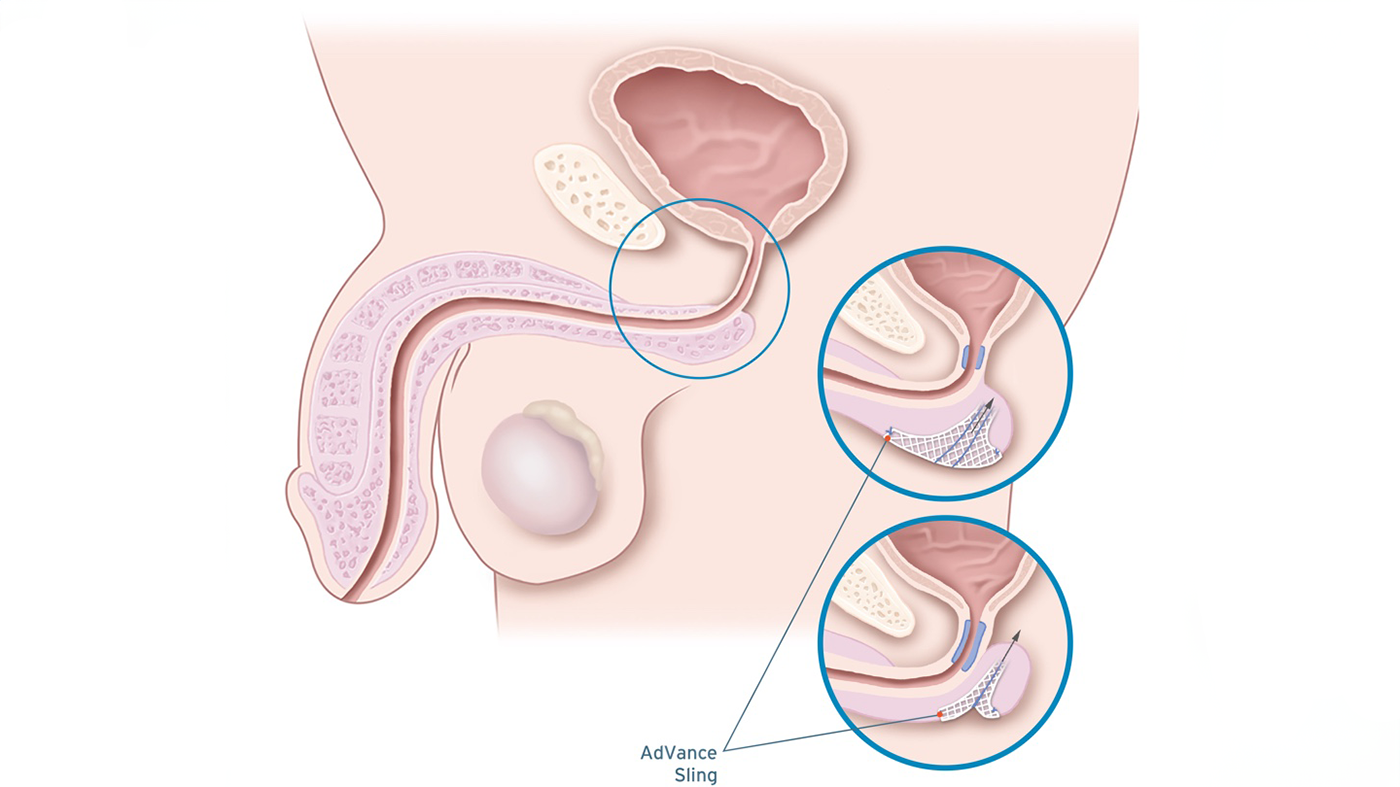 Illustration of an anatomical male pelvis with AdVance Sling.