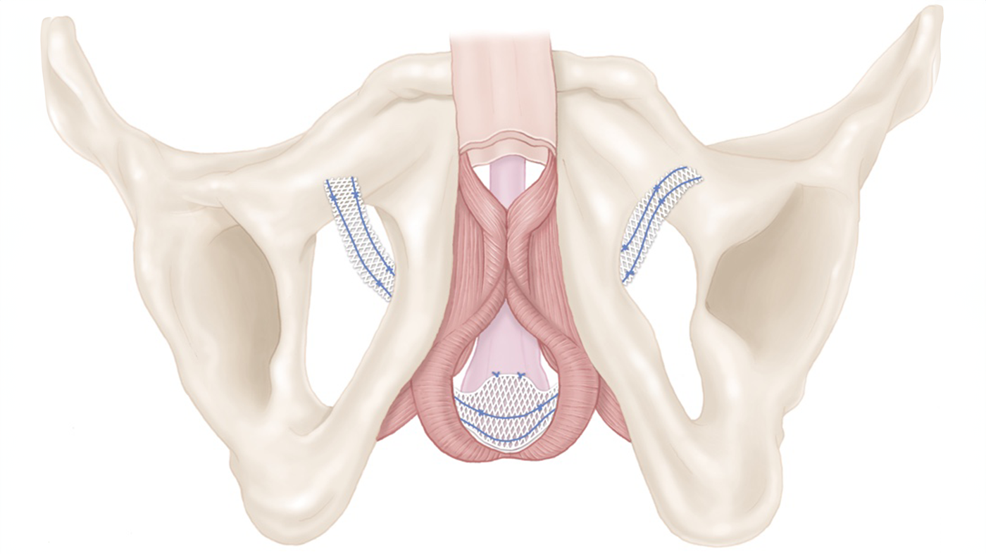Illustration of a pelvis.